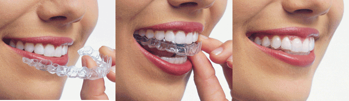 كيف- تصويب- أسنانك- في المنزل- بدون-- استخدام- من الأقواس -888