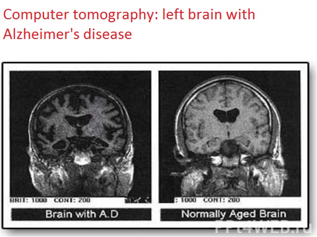 Alzheimer -dispozitie-1-62-3