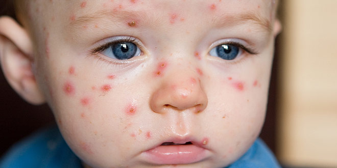 Chicken pox 222