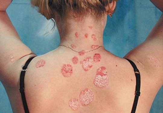 Cum să distingem - eczema- de-psoriazis-555-1