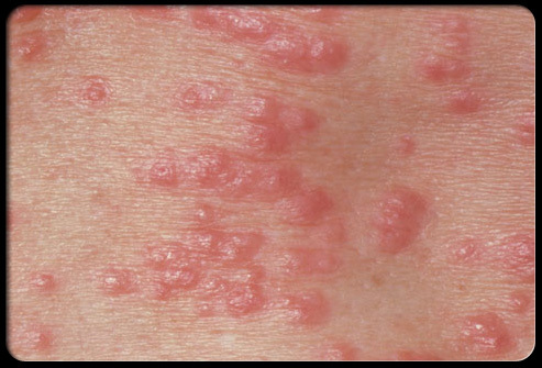 How- to- recognize- scabies-555-2