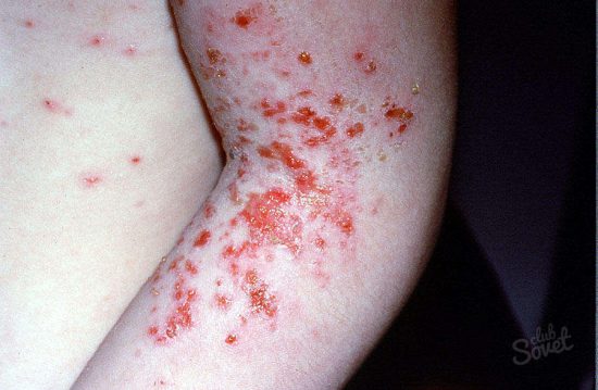 Sådan genkendes scabies-555-3