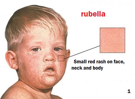 Rubella - în-copilul-1