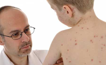 Rubella-in-the -child-2