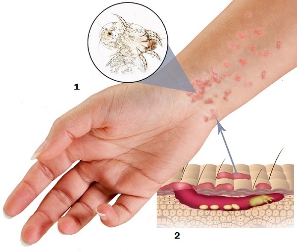 scabies-1