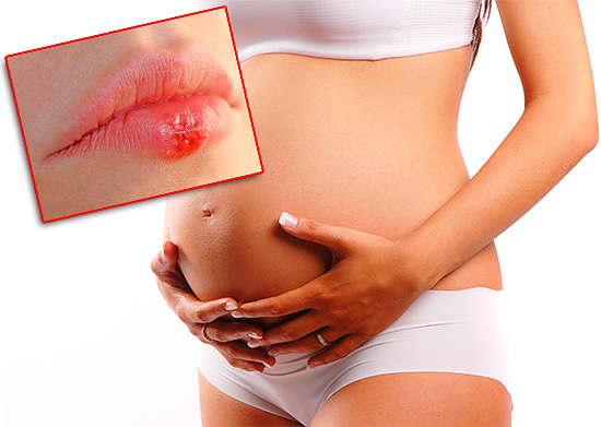 How To Treat Herpes On The Lips During Pregnancy 