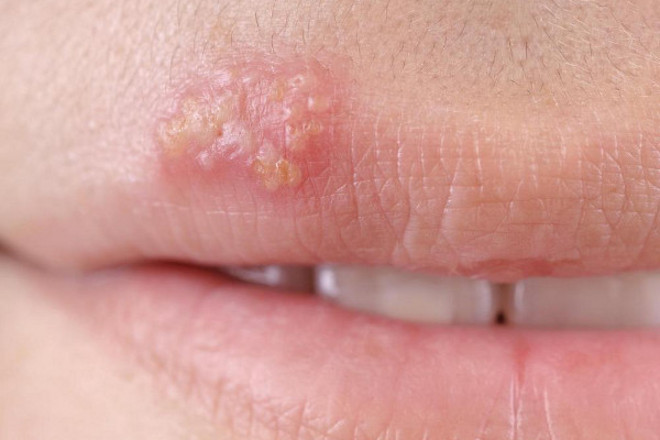 Herpes- on- the- lips-666