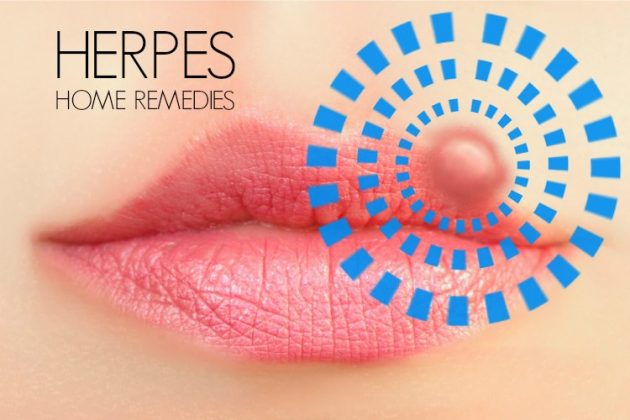 Herpes- on- the- lips-888