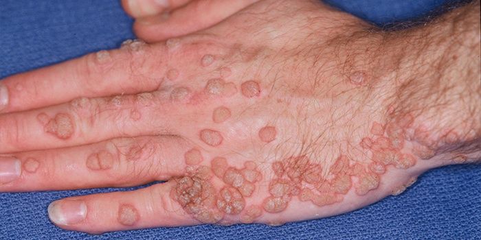 Warts on the fingers and hand