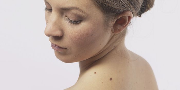 Brown moles on the body