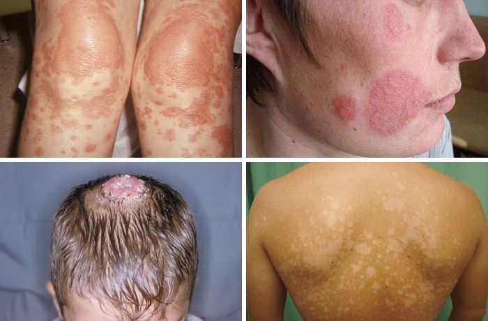 Symptomen van pityriasis versicolor