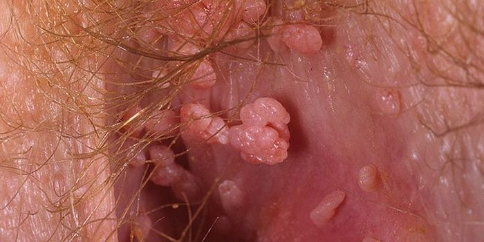 Papillomas in the vagina