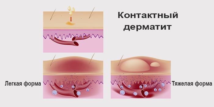 أشكال التهاب الجلد التماسي التحسسي