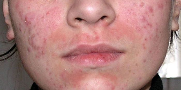 Demodecosis on the skin of the face