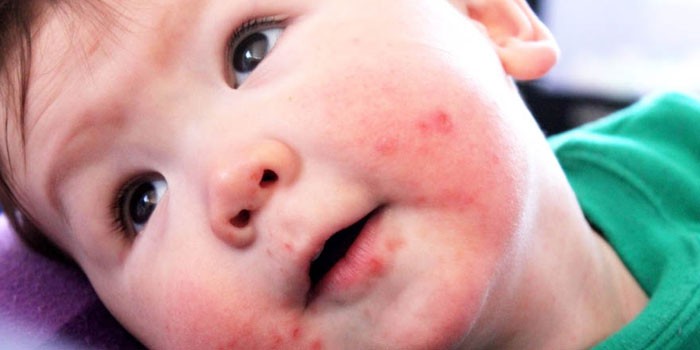 adenovirusnaja infekcija u detej i vzroslyh 2
