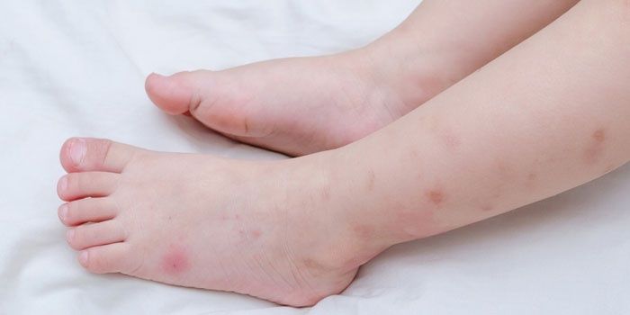 Rastros de picaduras de mosquitos en los pies de un niño