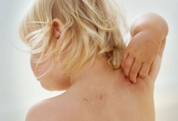 atopicheskij dermatit u detej lechenie narodnymi 1