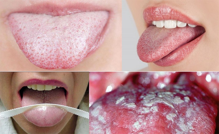 White coating on the tongue causes of the appearance in adults and