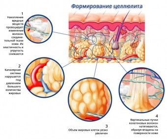 cellyulit kozha 1