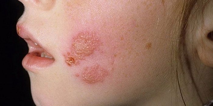 ? Ringworm in a girl on her cheek?
