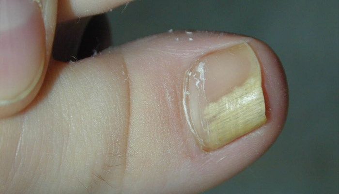 Fungal nail damage