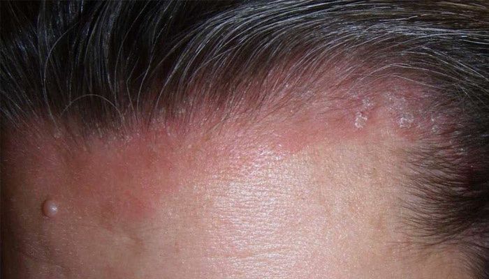 The scalp with signs of psoriasis