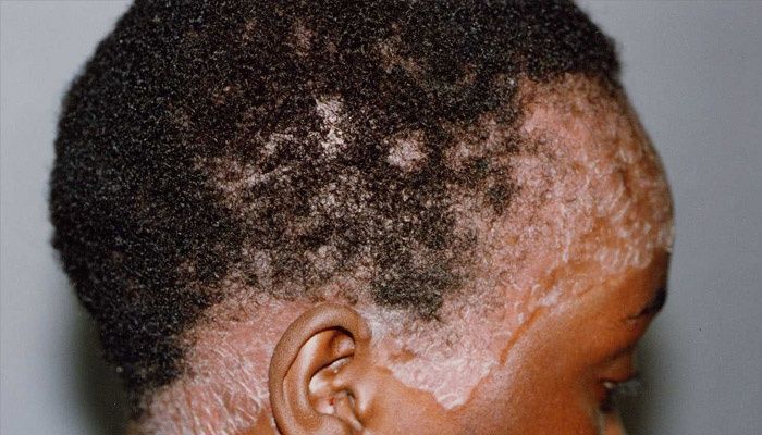 The manifestation of the disease on the head of a person