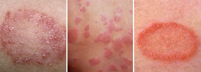 Bőrgombásodás tünetei és kezelése - HáziPatika