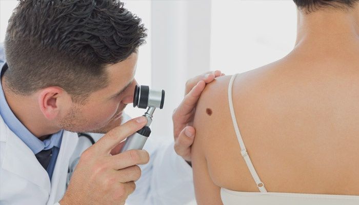A doctor examines a mole with a dermatoscope