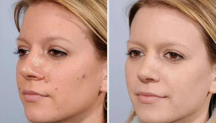 Girl before and after the procedure