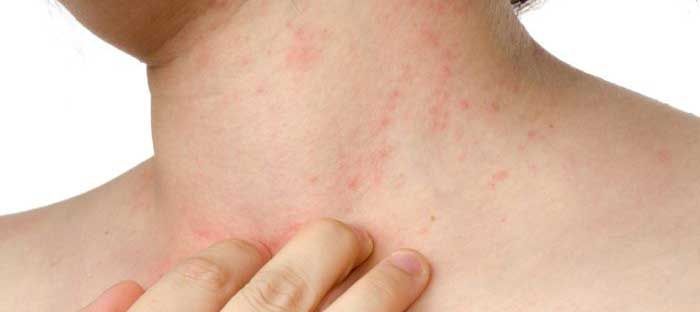 Treatment of psoriasis on the body