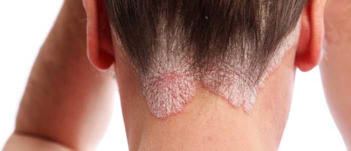 Psoriasis on the head and face
