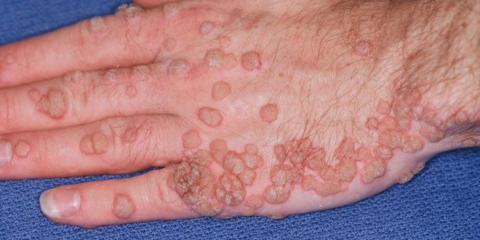 Skin papillomas on the hands
