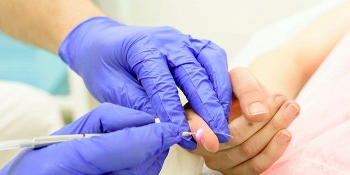 The doctor makes laser removal of papillomas from the skin of the patient’s finger