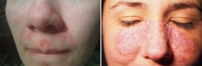 Psoriasis in the nose and eyes of a woman