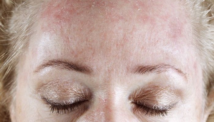 The manifestation of the disease on the skin of the forehead