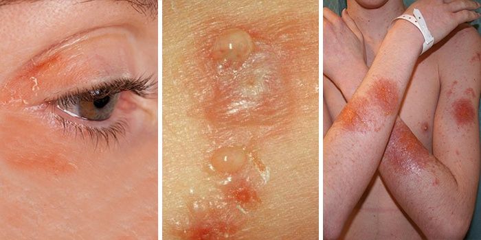Contact dermatitis on the face and hands