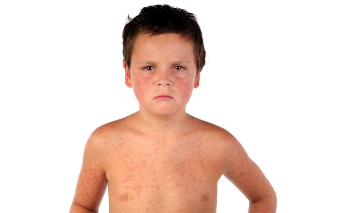 The manifestation of the disease on the skin of a child