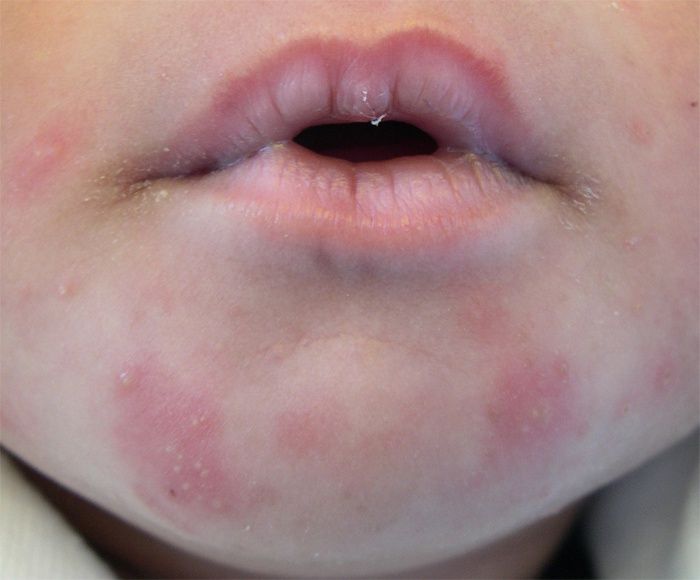 Spots on the face of a child