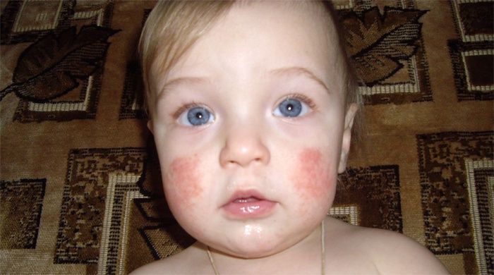 Psoriasis en niños pequeños.