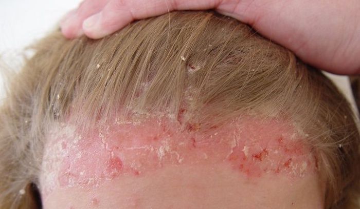 Plaques on the scalp