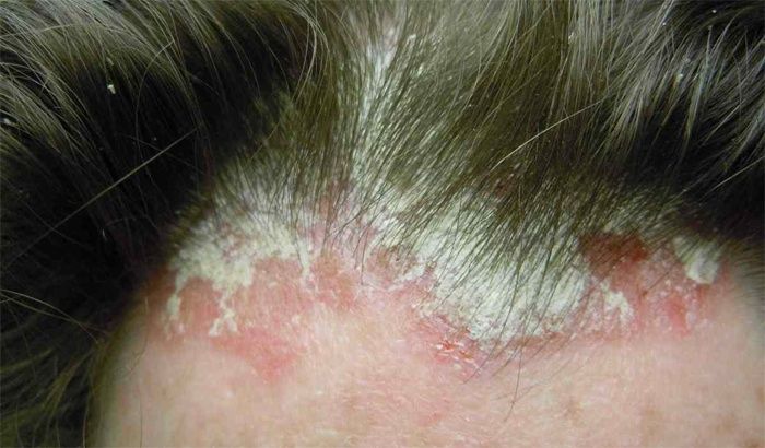 Psoriasis del cuero cabelludo