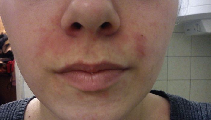 Symptome von Rosacea im Gesicht