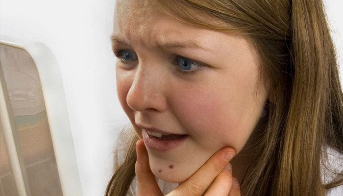 La niña tiene rosácea en la cara.