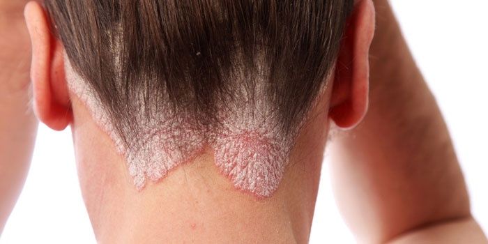 Psoriasis on the occipital part of the head