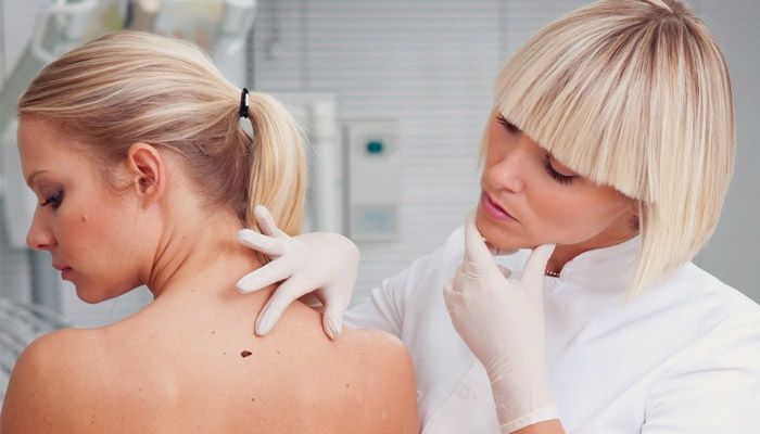Dermatologist examines papillomas on the body of a girl