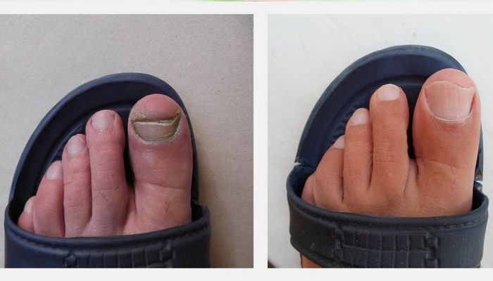 Unhas antes e depois do tratamento